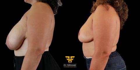 Réduction mammaire à Montpellier