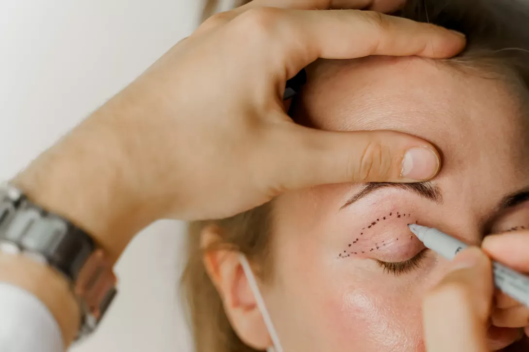 Marquage préopératoire des paupières supérieures avant une blépharoplastie réalisée par un chirurgien esthétique.